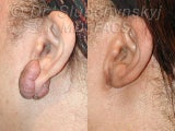 Keloid Removal