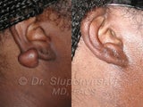 Keloid Removal