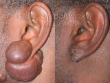 Keloid Removal