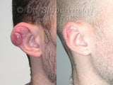 Keloid Removal