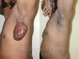 Keloid Removal