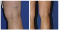 Sclerotherapy