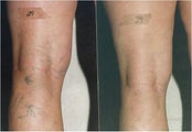 Vein Removal with Sclerotherapy