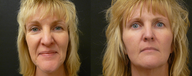 Liquid Facelift - no surgery enhancement using fillers