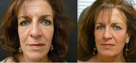 Sculptra combined with Botox creates a beautiful liquid facelift