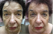 Sculptra facial rejuvenation