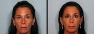 Sculptra