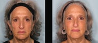 Sculptra