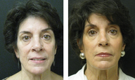 Liquid Facelift - fillers