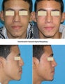 Functional and Cosmetic Closed Septorhinoplasty result