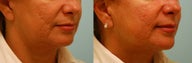Acne Scarring Correction