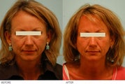 Acne Scarring Correction