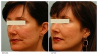 Acne Scarring Correction