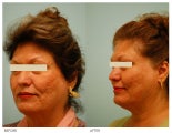 Acne Scarring Correction