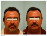 Acne Scarring Correction