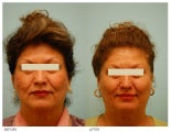 Acne Scarring Correction