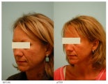Acne Scarring Correction