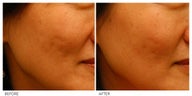 Acne Scarring Correction