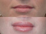 Lip Augmention with Silicone