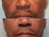 Nasal Labial Fold Correction with Silicone