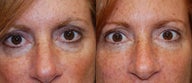 Silikon-1000 to treat lower eyelid "bags"
