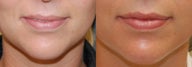 Lip Augmentation with Silikon-1000