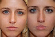 Silikon-1000 to Lower Eyelid Grooves, and Laugh Lines