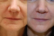 Silikon-1000 for non-surgical rejuvenation around the mouth
