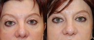 Silikon-1000 to correct lower eyelid irregularities after blepharoplasty