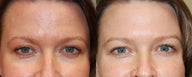 Non-Surgical Facial Rejuvenation with BOTOX Cosmetic and Silikon-1000