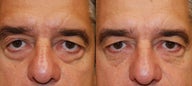 Silikon-1000 Injectable Filler Treatment for Lower Eyelid Bags