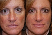 Liquid Face Lift, Non-Surgical Facial Rejuvenation