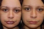 Silikon-1000, Permanent Injectable Filler for Lower Eyelid Bags