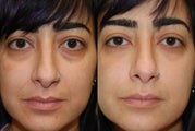 Silikon-1000, Injectable Filler treatment for lower eyelid "bags" and naso-labial folds.