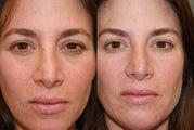 Non-Surgical Facial Rejuvenation with Silikon-1000 and Botox