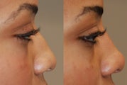 Non-Surgical Rhinoplasty with Silikon-1000