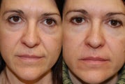 Non-Surgical Facial Rejuvenation with Silikon-1000