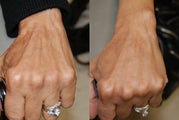 Hand Rejuvenation with Silikon-1000