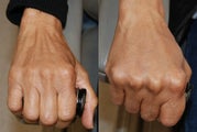 Hand Rejuvenation using Silikon-1000