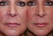 Silikon-1000 for Lip Augmentation and Marionette Grooves