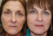 Non-Surgical Facial Rejuvenation with Silikon-1000 and Botox Cosmetic.