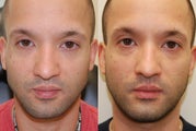 Correction of a crooked Chin Implant with Silikon-1000