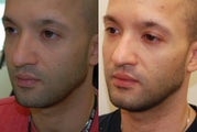 Correction of a crooked Chin Implant with Silikon-1000