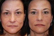 Non-surgical facial rejuvenation with Silikon-1000 and Botox.