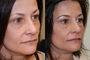 Non-Surgical Facial rejuvenation with Silikon-1000 and Botox.