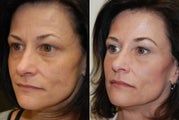 Non-surgical facial rejuvenation with Silikon-1000 and Botox.