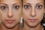 Non-Surgical Rhinoplasty with Silikon-1000
