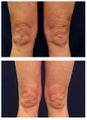 Laser Skin Tightening