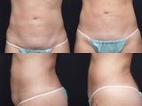 SlimLipo