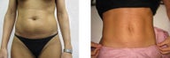 Slim Lipo laser liposuction and mini tummy tuck